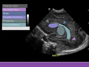 MB Peds Sono Cranial Sweep.pptx